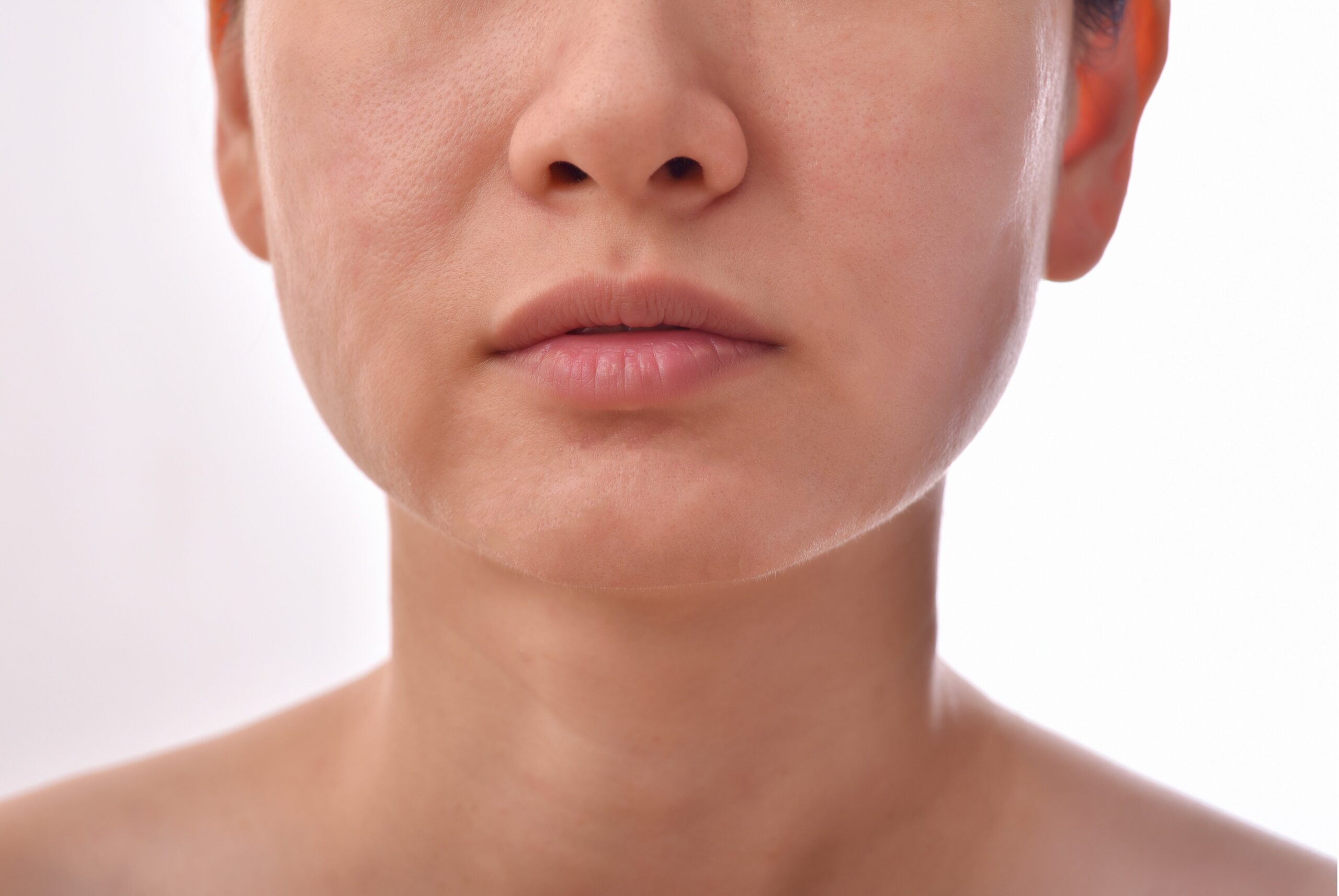 Skin problems and acne scar, Before and after acne facial care treatment, Beauty concept.